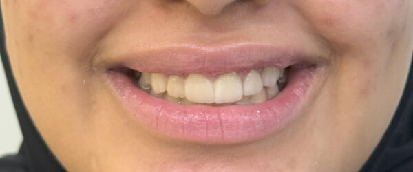 best-dental-veneer-treatment-dubai-after