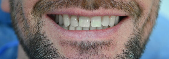 dental-after