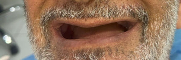 denture-treatment-dubai-before denture-treatment-dubai-before