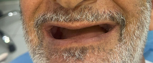 denture-treatment-dubai-before denture-treatment-dubai-before