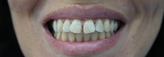dental-before 2