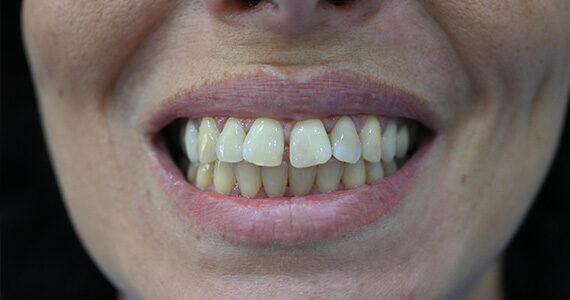 dental-before 2