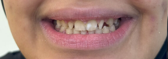 best-dental-veneer-treatment-dubai-before