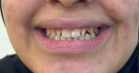 best-dental-veneer-treatment-dubai-before