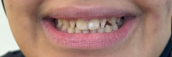 best-dental-veneer-treatment-dubai-before best-dental-veneer-treatment-dubai-before