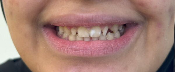 best-dental-veneer-treatment-dubai-before best-dental-veneer-treatment-dubai-before