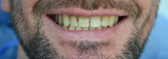 dental-before