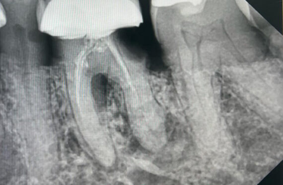 endo-nooh-after 2 endo-nooh-after 2