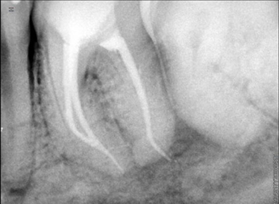 endo-nooh-after 3