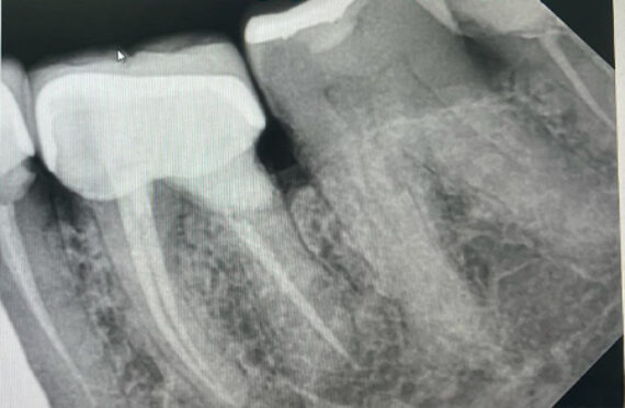 endo-nooh-before 2 endo-nooh-before 2