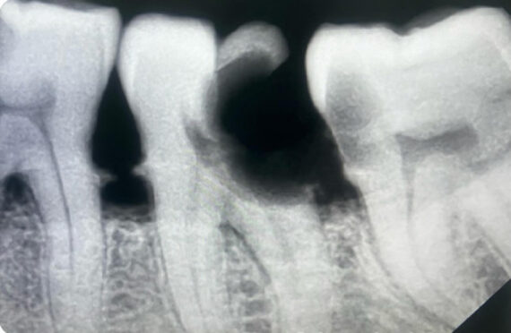 endo-nooh-before endo-nooh-before