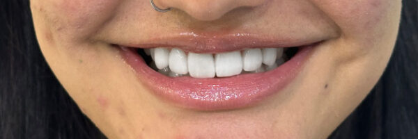 whitening-after