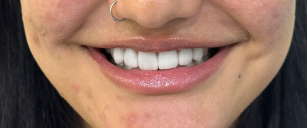 Dental-vaneer-treatment-dubai-after