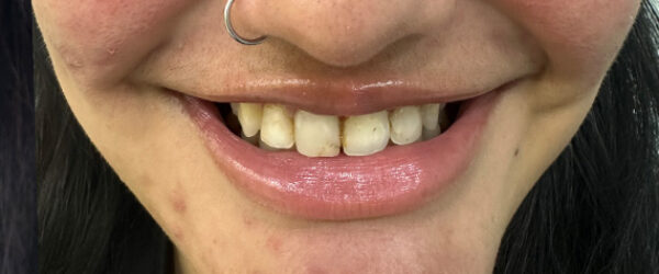 Dental-vaneer-treatment-dubai-before