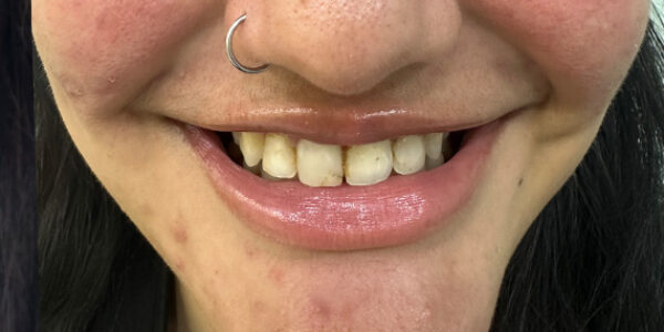 whitening-before