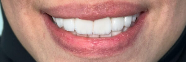 vaneer-treatment-dubai-after