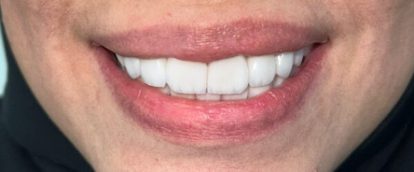 vaneer-treatment-dubai-after