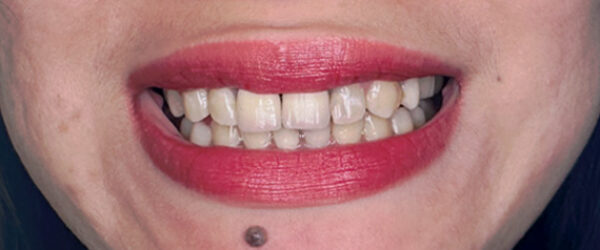 vaneer-treatment-ras-al-khaimah-before vaneer-treatment-ras-al-khaimah-before