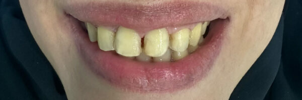 vaneer-treatment-dubai-before vaneer-treatment-dubai-before