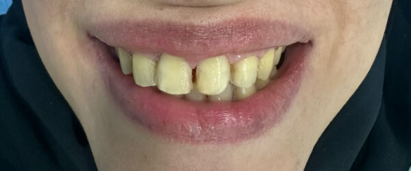 vaneer-treatment-dubai-before vaneer-treatment-dubai-before