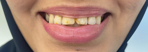 top-dental-veneer-treatment-dubai-before top-dental-veneer-treatment-dubai-before