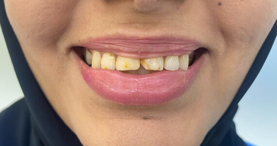top-dental-veneer-treatment-dubai-before top-dental-veneer-treatment-dubai-before