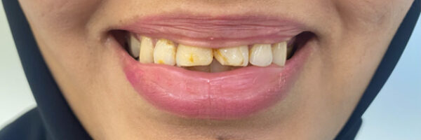 top-dental-veneer-treatment-dubai-before top-dental-veneer-treatment-dubai-before