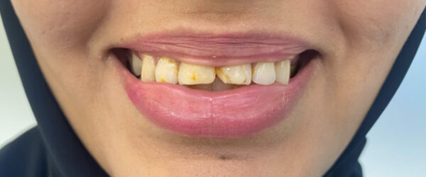 top-dental-veneer-treatment-dubai-before top-dental-veneer-treatment-dubai-before