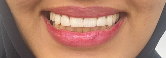 top-dental-veneer-treatment-dubai-after