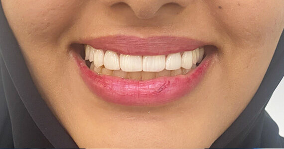 top-dental-veneer-treatment-dubai-after