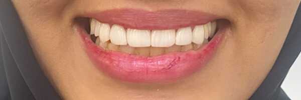 top-dental-veneer-treatment-dubai-after
