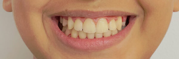 braces-treatment-uae-after