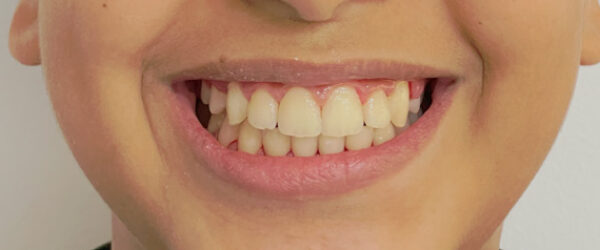 braces-treatment-uae-after