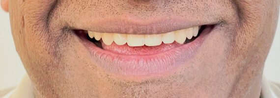 top-braces-treatment-dubai-after