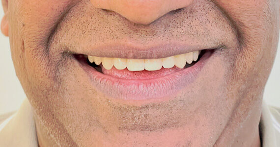 top-braces-treatment-dubai-after