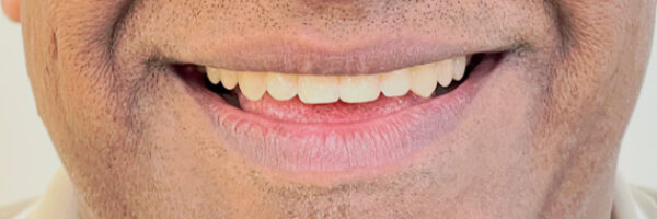 top-braces-treatment-dubai-after