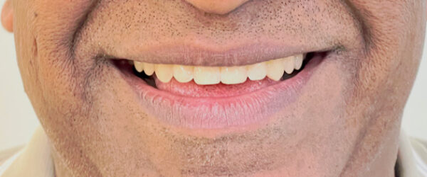 top-braces-treatment-dubai-after