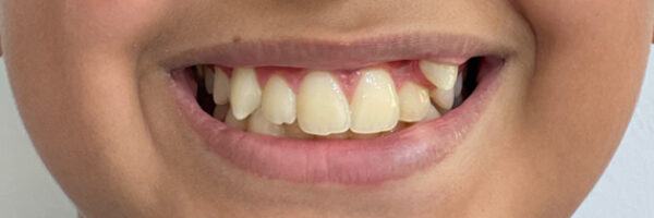 braces-treatment-uae-before braces-treatment-uae-before
