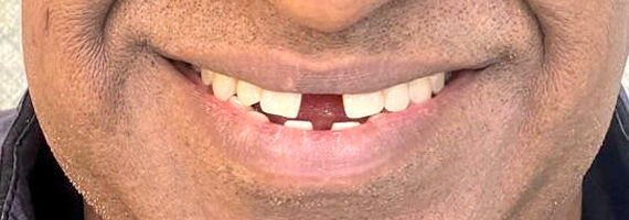 top-braces-treatment-dubai-before top-braces-treatment-dubai-before