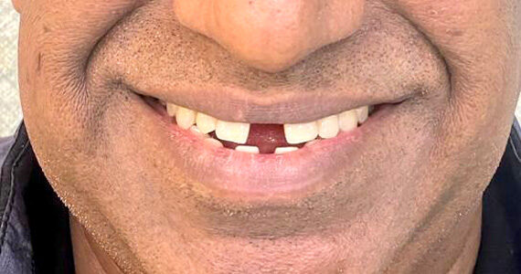 top-braces-treatment-dubai-before top-braces-treatment-dubai-before