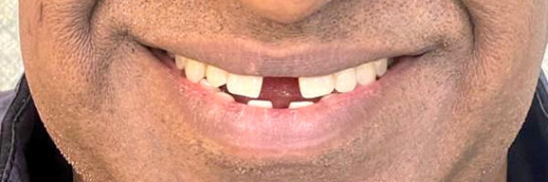 top-braces-treatment-dubai-before top-braces-treatment-dubai-before