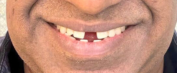 top-braces-treatment-dubai-before top-braces-treatment-dubai-before