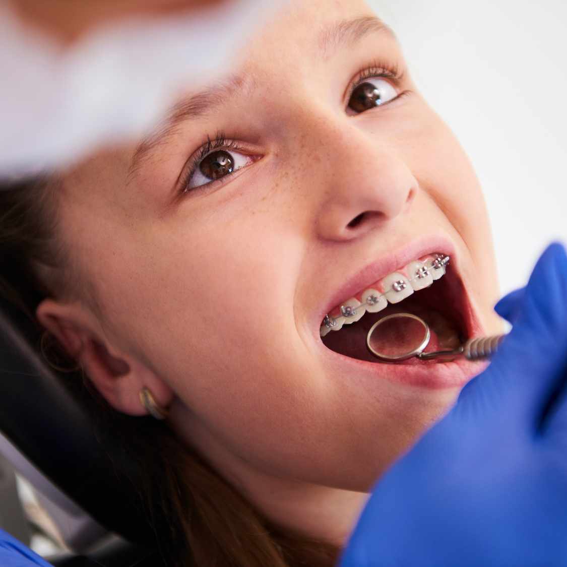 best-metal braces-in-dubai