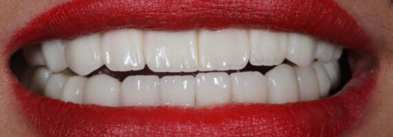 best-vaneer-treatment-rigga-after