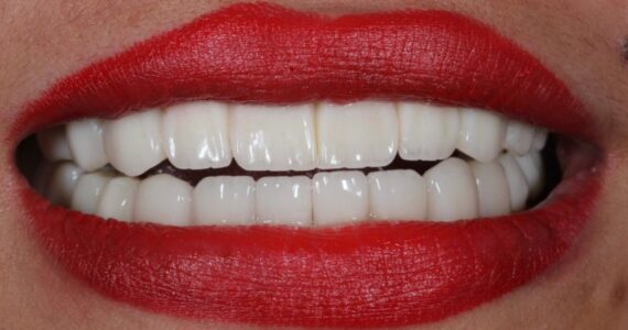 best-vaneer-treatment-rigga-after