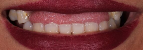 best-vaneer-treatment-rigga-before best-vaneer-treatment-rigga-before