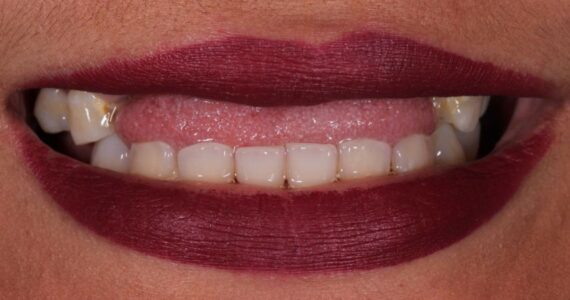 best-vaneer-treatment-rigga-before best-vaneer-treatment-rigga-before