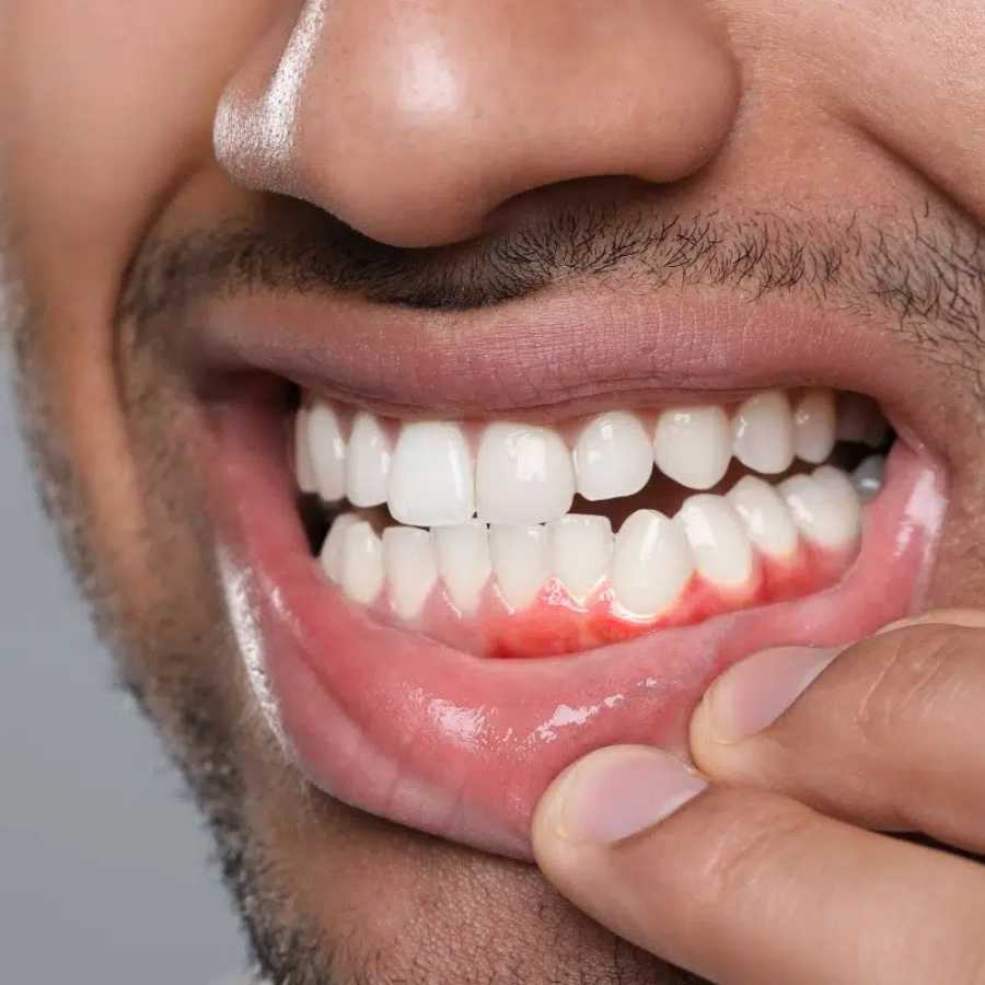 gum-recession-treatment-in-dubai