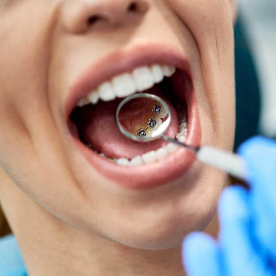 lingual-braces-in-dubai