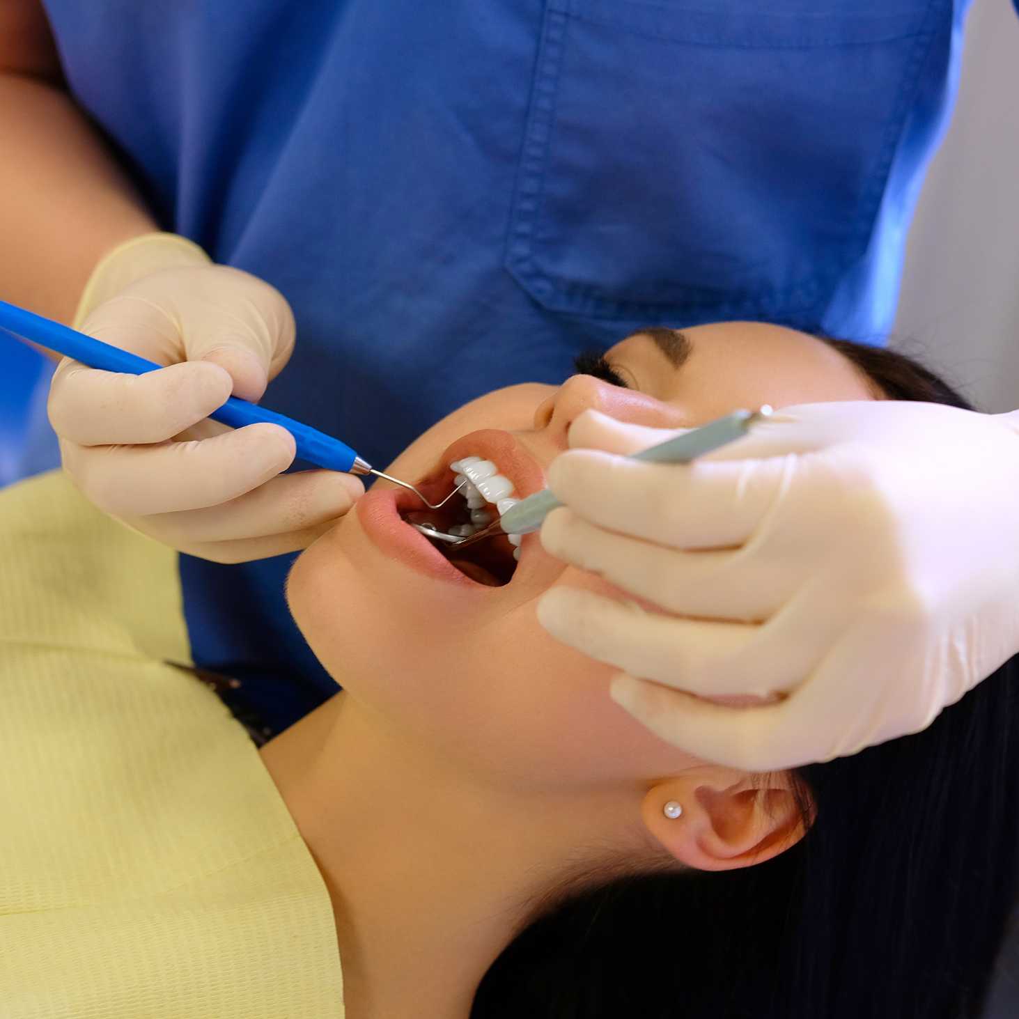 teeth-filling-in-dubai